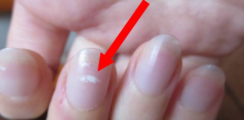 ¿Por qué aparecen? Manchas blancas en las uñas - Kebuena
