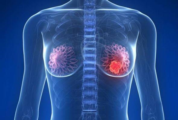 tumor maligno vs benigno