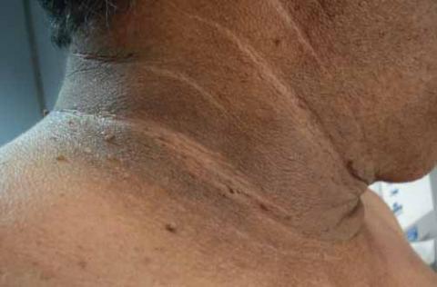 acantosis pigmentaria 