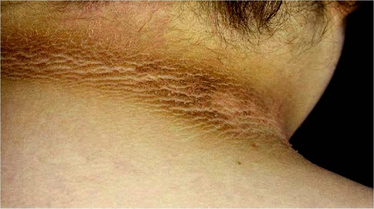 acantosis pigmentaria 