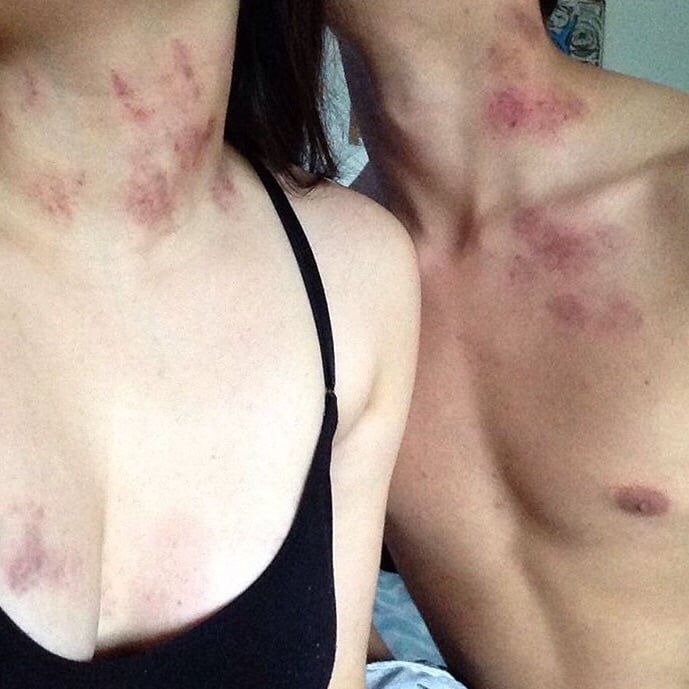 ¿Te mordió un vampiro? Aquí las mejores maneras de quitar un chupetón