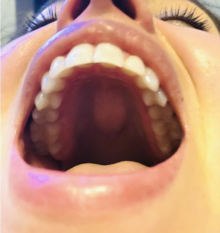 Si eres del 30 que tiene un bulto en el paladar, esto debes saber