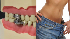 Crean dispositivo para cerrar la boca y poder bajar de peso